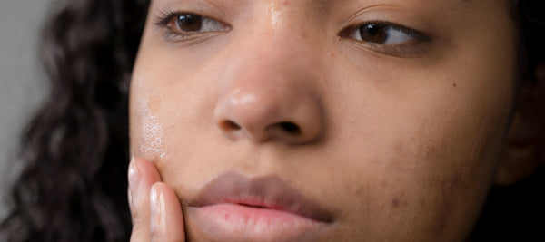 Do You Struggle With Acne Scars?